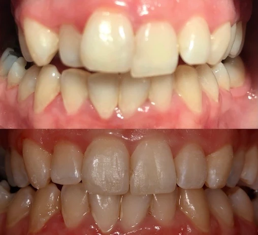 Clear aligners

Before and after with the help of clear aligners to straighten the teeth.
