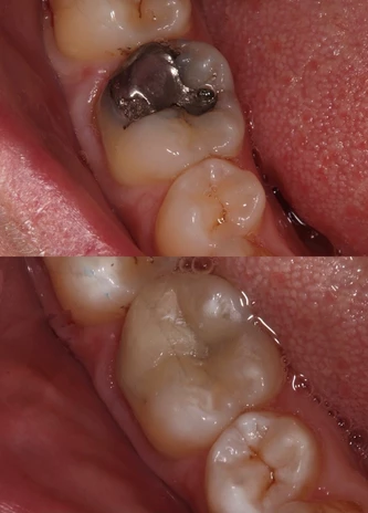 Amalgam restoration replacement
BEFORE: Historically placed amalgam.

AFTER: Amalgam carefully removed and replaced with a more aesthetically pleasing composite restoration.