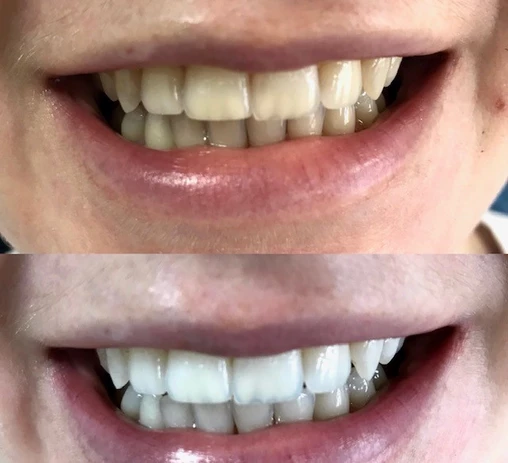 Whitening case

Before and After: the results speak for themselves!