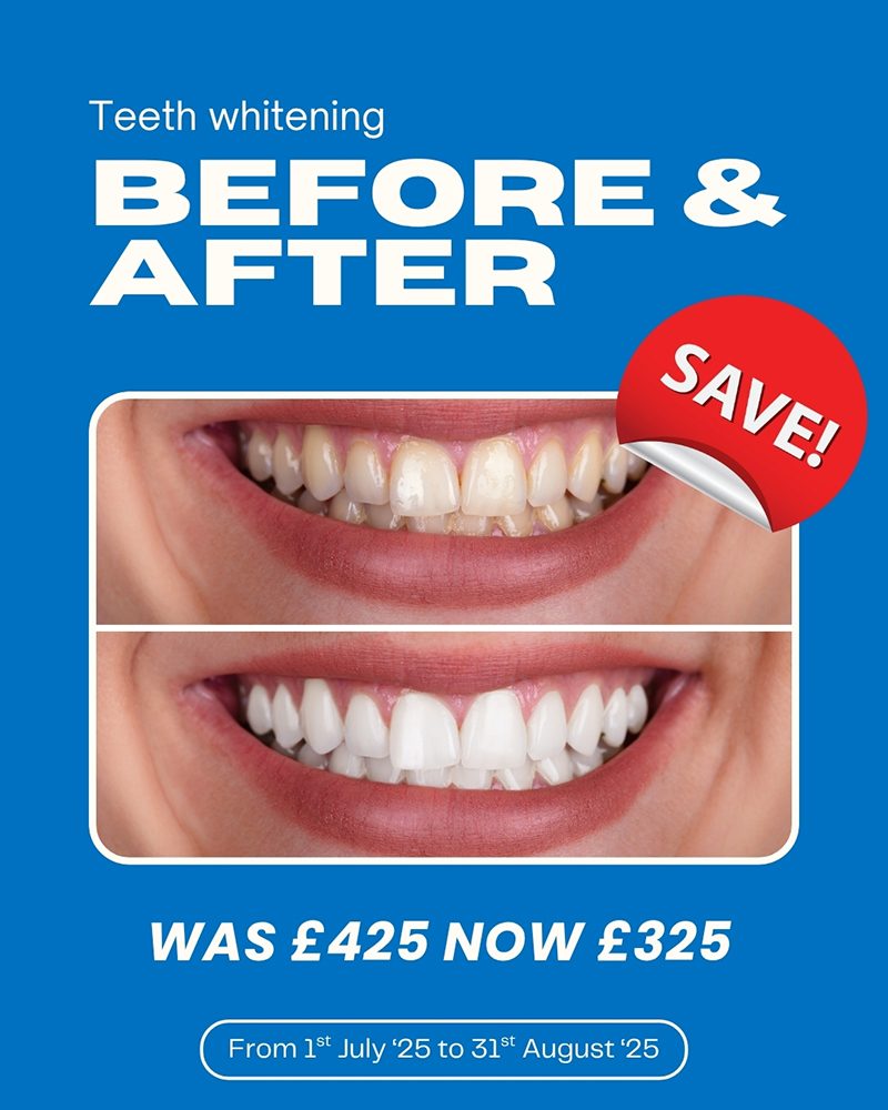 Teeth Whitening